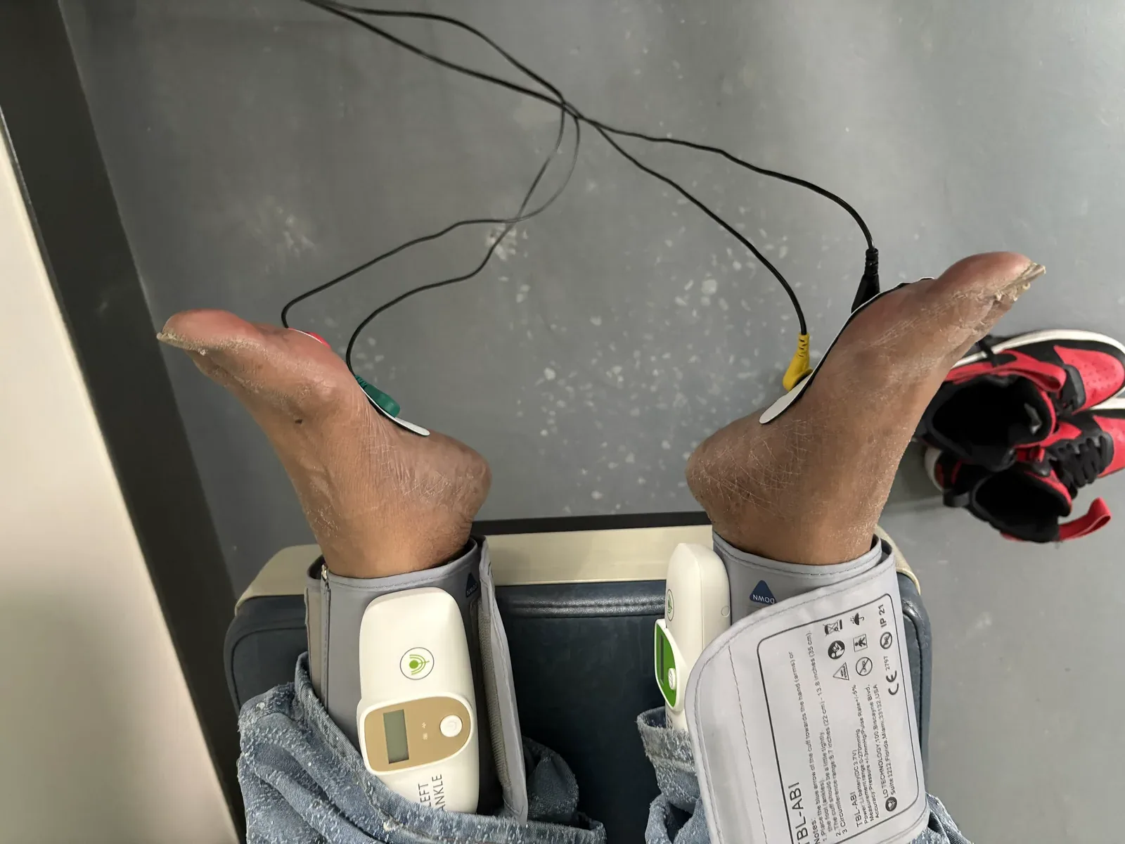 Ankle blood pressure cuffs and sensors placed on a patient's feet during ankle-brachial index testing at Regenerve, 4477 Woodson Rd #104, St. Louis, MO 63134