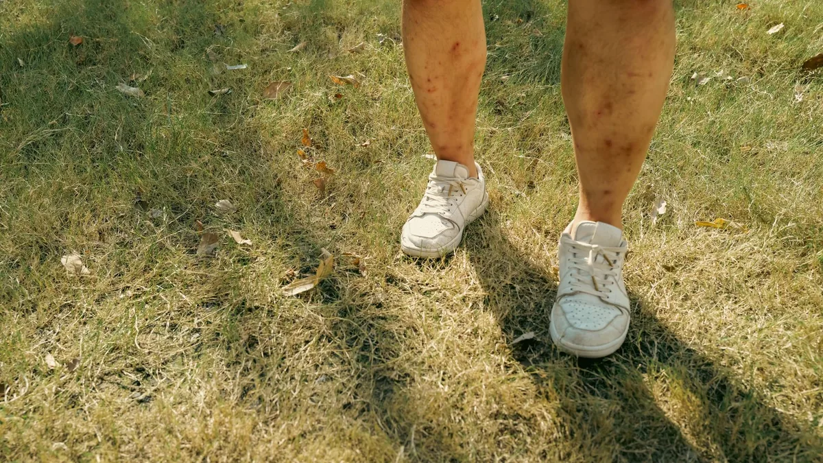Restless legs syndrome versus peripheral neuropathy: how to tell the difference