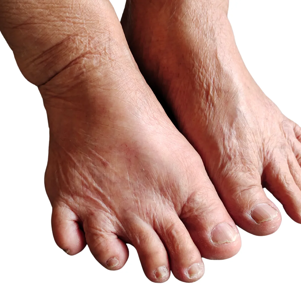 Bare feet of an older adult showing dry skin, thickened toenails and bunion deformity, the appearance often seen alongside peripheral neuropathy of the feet